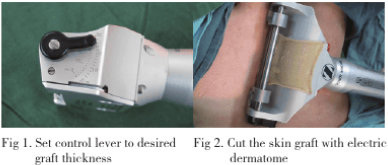 电动取皮刀在前臂皮瓣供区缺损修复中的应用